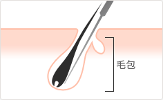 脱毛方法の図